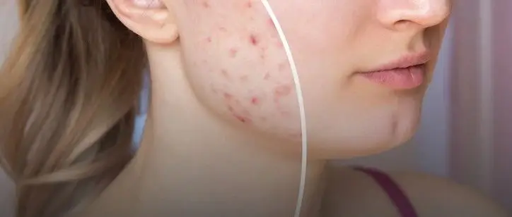 Recurring Acne: The Culprit Might Be This Gynecological Condition